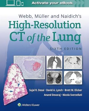 Webb, Müller and Naidich’s High-Resolution CT of the Lung 6th Edition PDF eBook – Instant Download